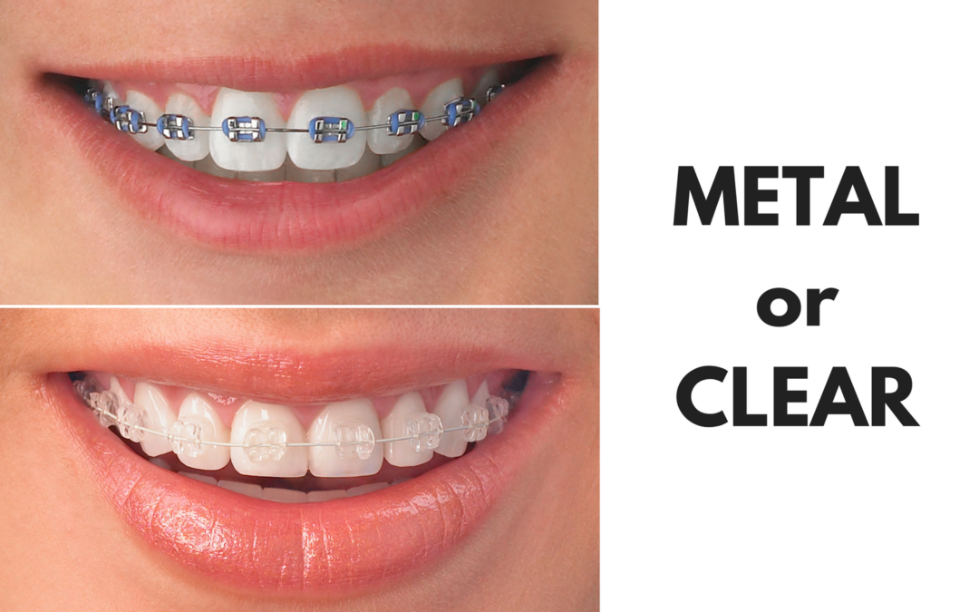 Ask Your Tyler and Longview Orthodontist: Should I Get Metal or Clear Braces?