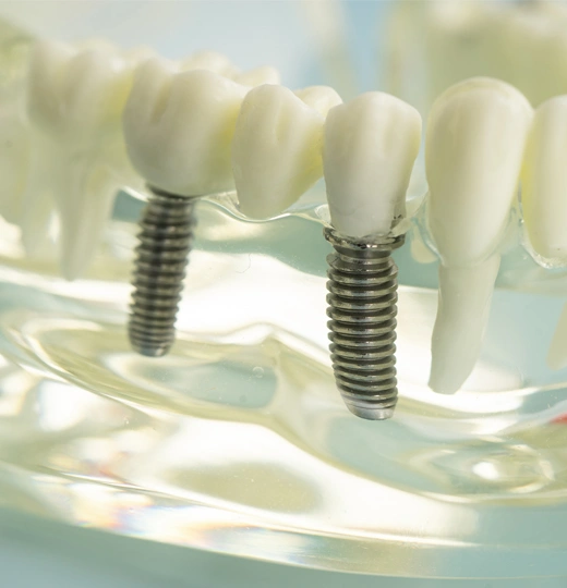 img-what-are-dental-implant