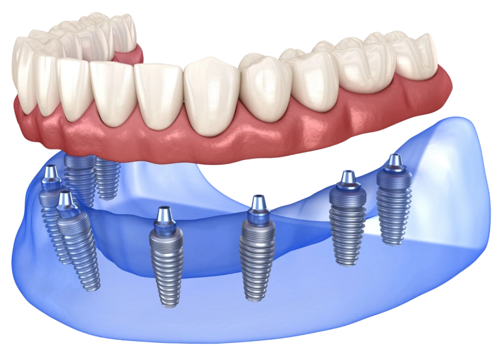 implant-1
